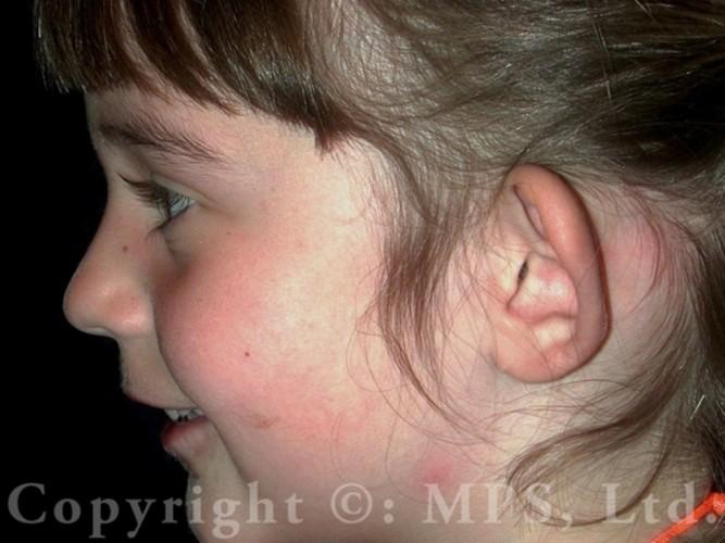 Before (age 5)