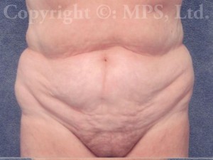 Before (after liposuction elsewhere)