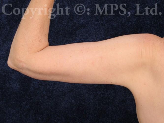 After (6 weeks post-op)