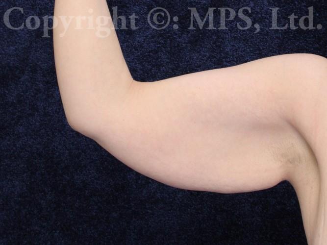 Right arm Before (after 100+ pound weight loss)