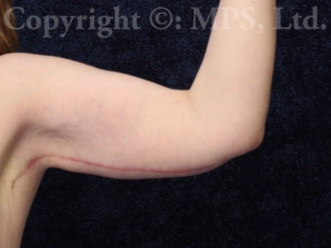 Left arm After (3 months post-op)
