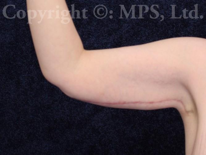 Right arm After (3 months post-op)