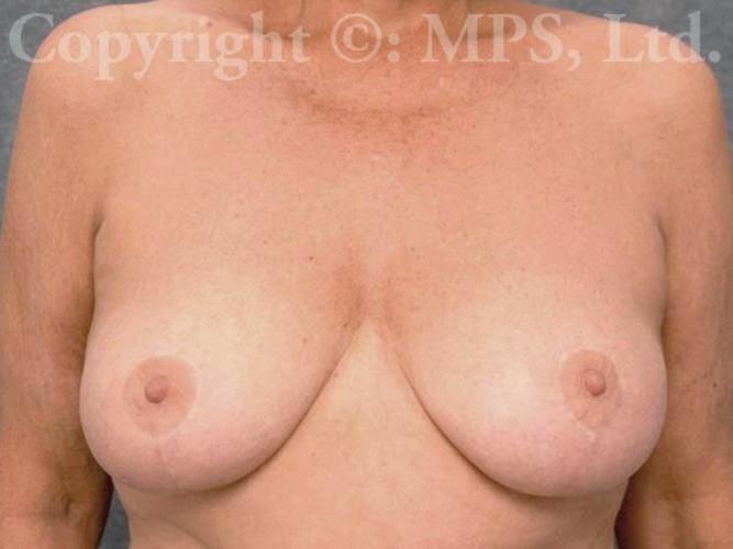 After (7 years post-op; age 64)