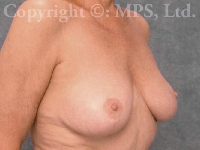 After (7 years post-op; age 64)