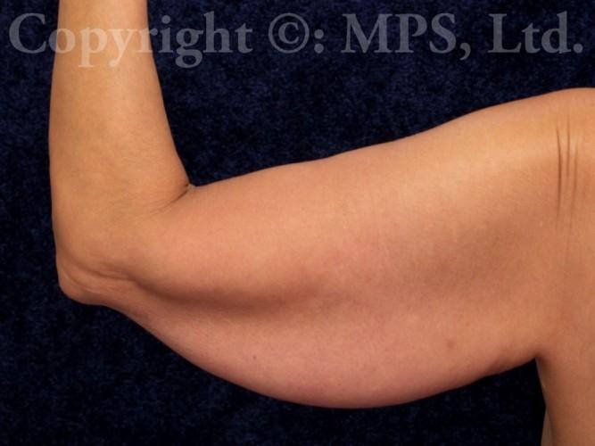 Before (Left arm posterior view)