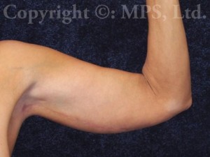 After (Left arm, 5 months post-op)