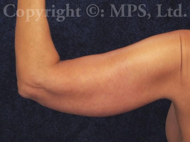 After (Left arm posterior view; 5 months post-op)