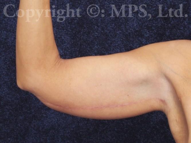 After (Right arm, 5 months post-op)