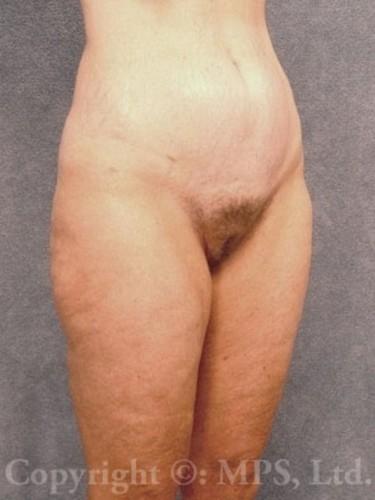 After (6 months post-op)