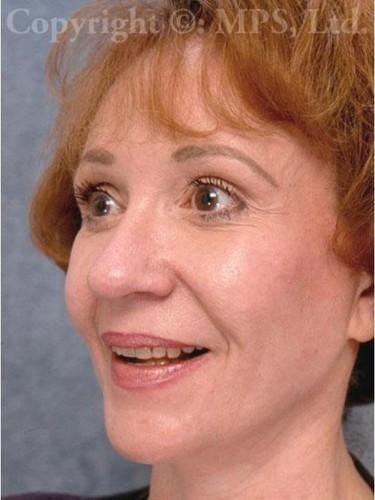 After (8 mo.after facial surgery)