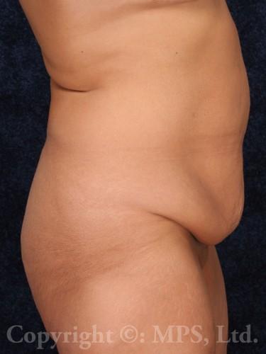 Before belt lift; After breast lift plus implants
