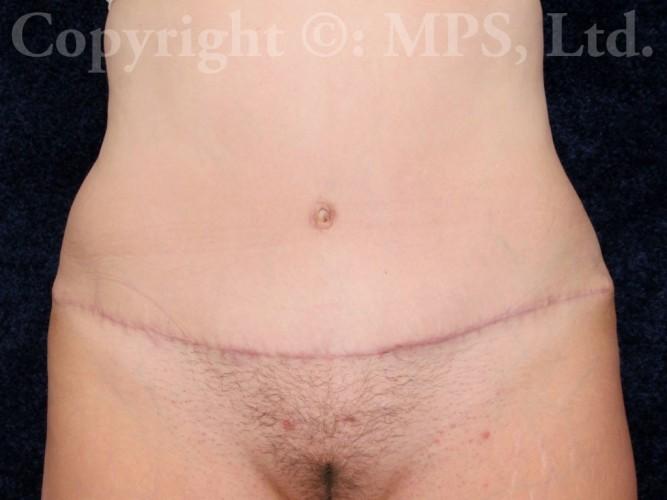 After (6 months post-op)