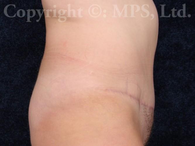 After (6 months post-op)