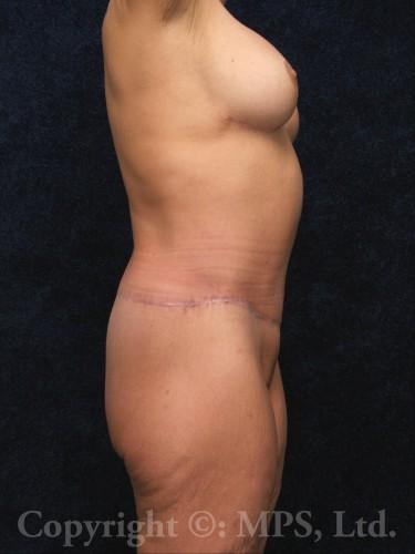 3 months after beltlift; 6 months after breast lift plus implants