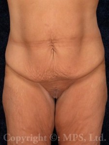 Before belt lift; After breast lift plus implants