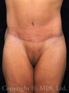 3 months after beltlift; 6 months after breast lift plus implants