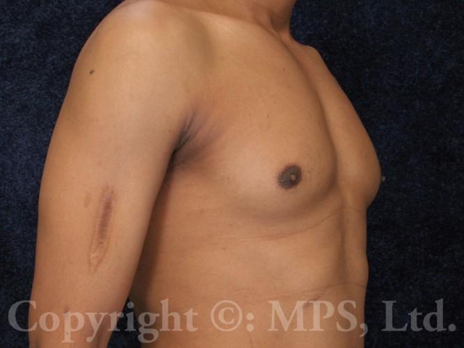 After (5 years post-op)