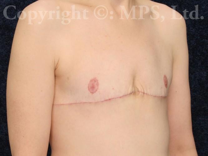 After (5 weeks post-op)