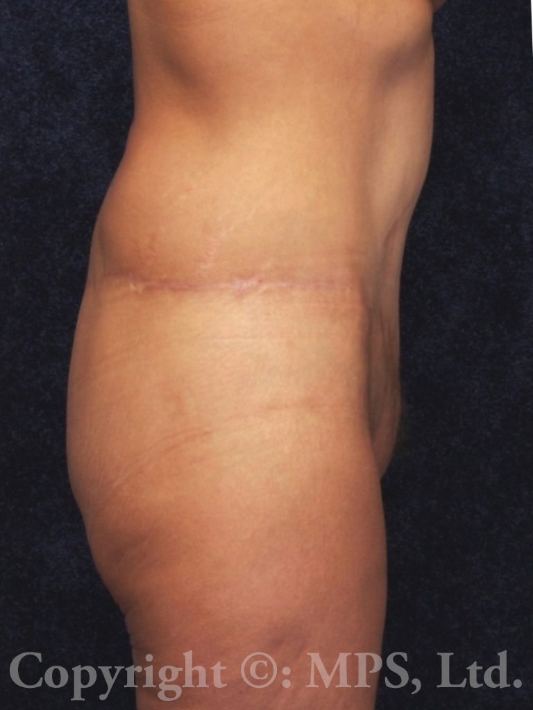 After (7 months post-op)