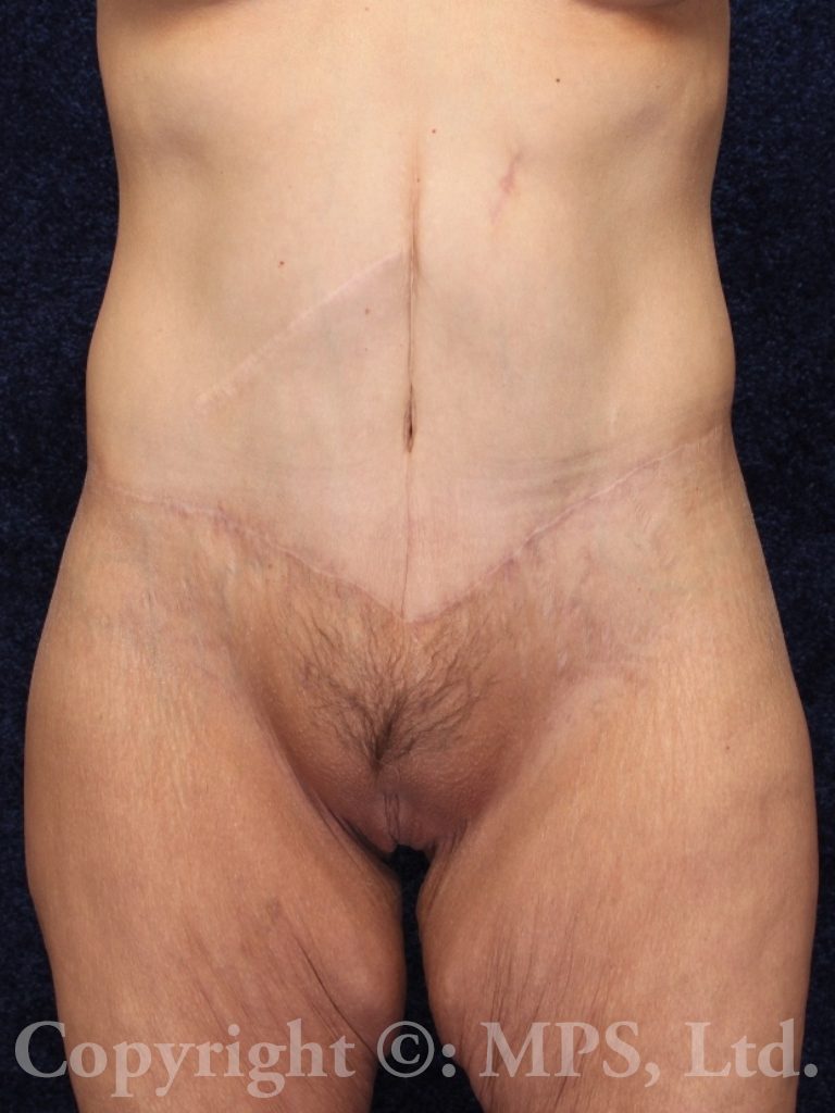 After (7 months post-op)