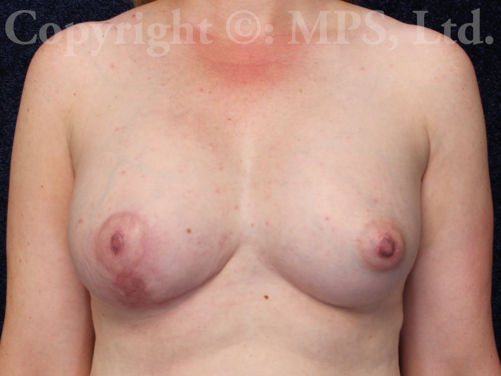 After (3 months post-op)