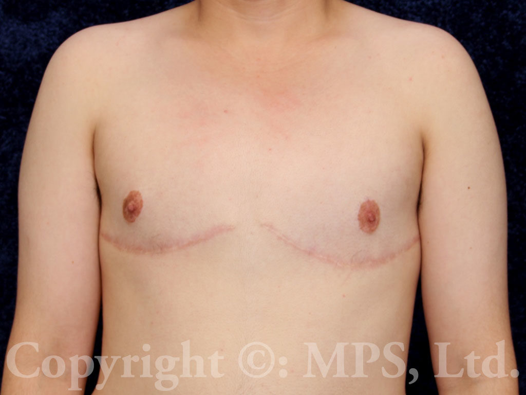 After 1 year post-op)