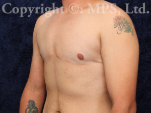 After (1 year post-op)