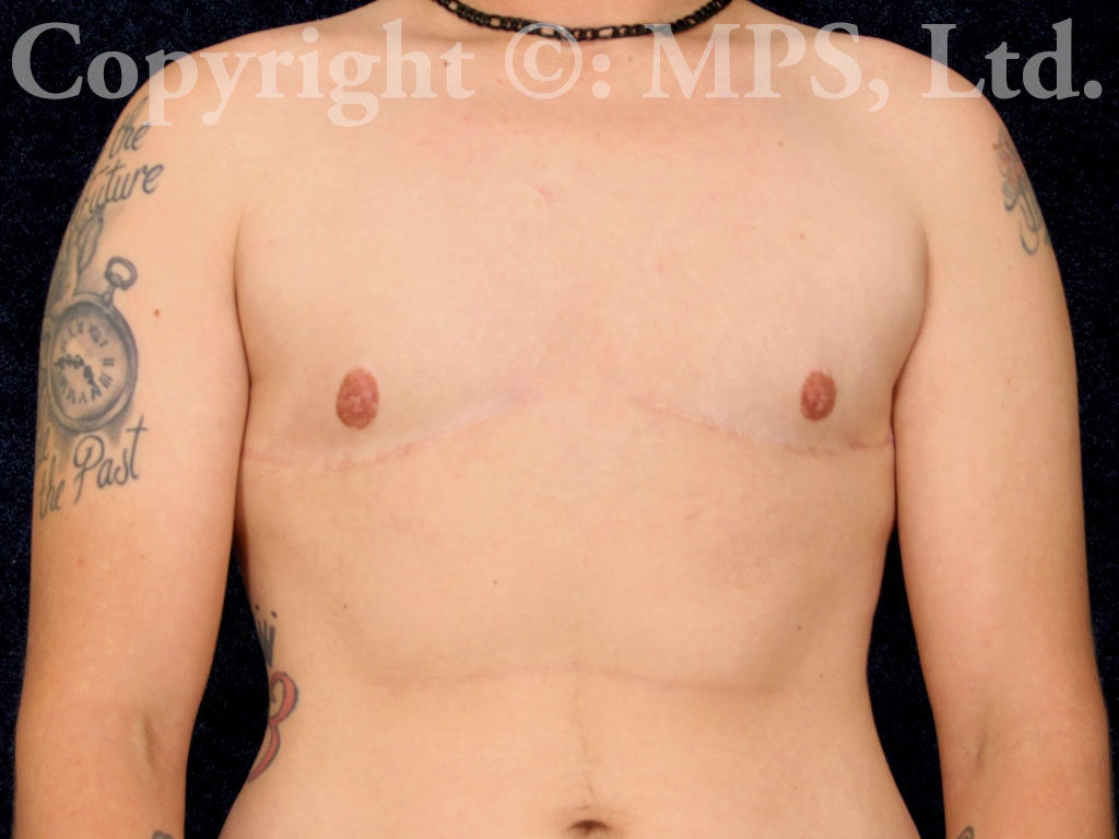 After (2 years post-op)
